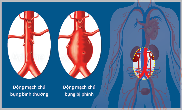 Bệnh viện Hoàn Mỹ Sài Gòn không ngừng cập nhật kỹ thuật mới, nhằm nâng cao hiệu quả điều trị cho người mắc bệnh tim mạch 