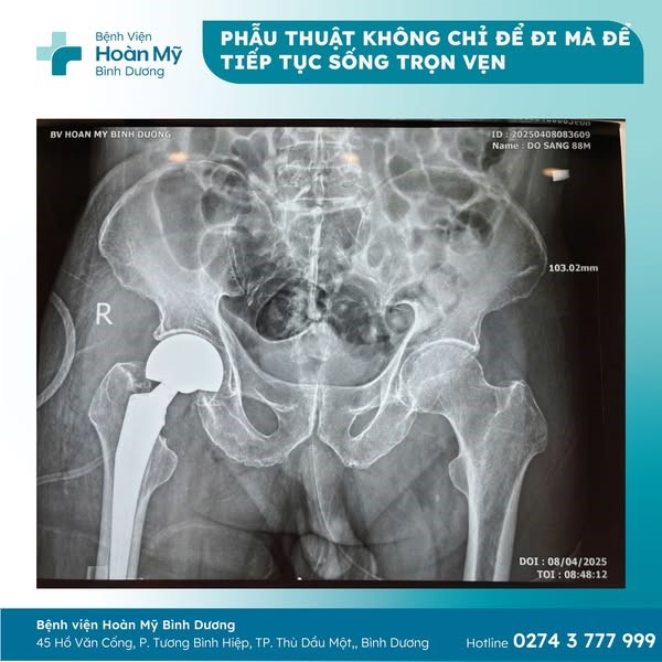 Phẫu thuật thay khớp háng cho người cao tuổi thuận tiện trong sinh hoạt