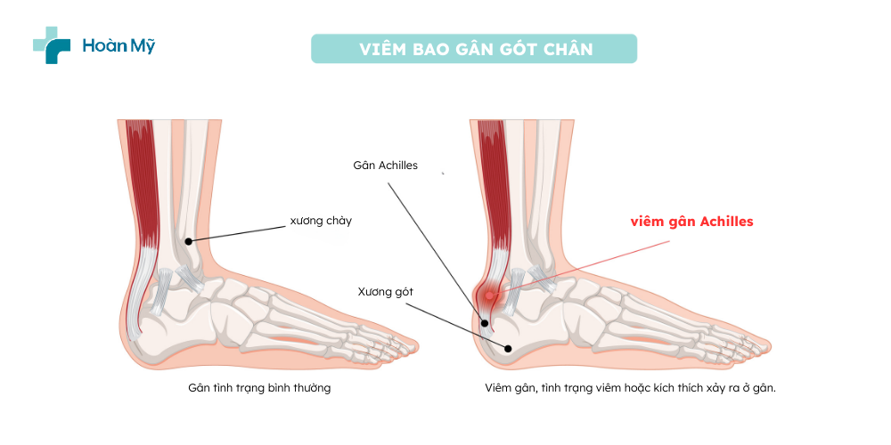 Viêm bao gân gót chân ở người chạy bộ – Nguyên nhân và giải pháp