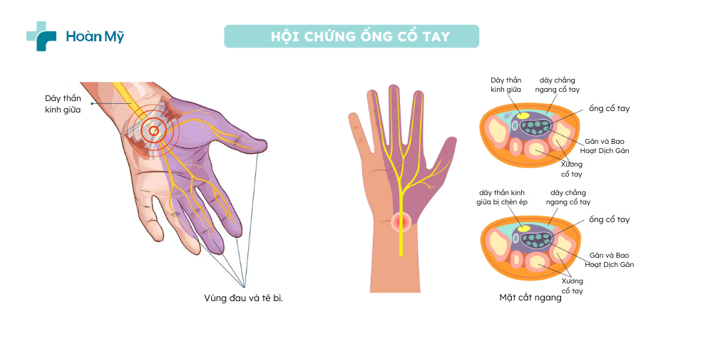 Hội chứng ống cổ tay – Nguyên nhân, triệu chứng và cách điều trị hiệu quả