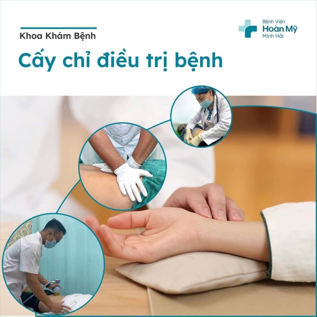 Cấy chỉ điều trị bệnh tại Bệnh viện Hoàn Mỹ Minh Hải