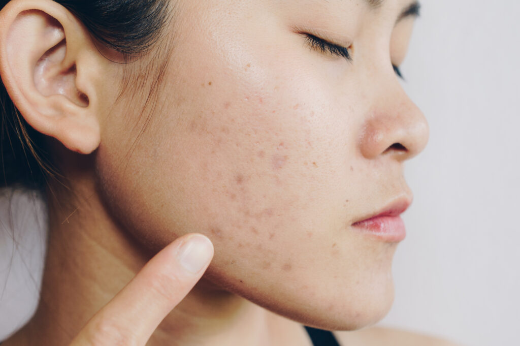 Những điều cần biết về mụn trứng cá