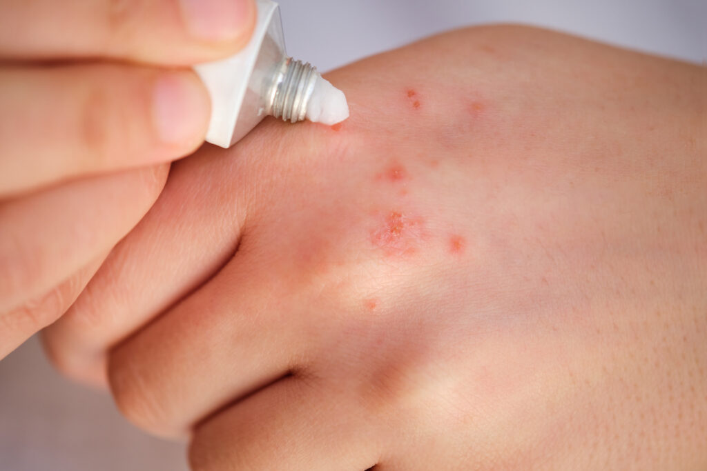 Bôi thuốc vào vùng da mẩn đỏ để thải độc da nhiễm corticoid và ngăn ngừa lây lan các vùng da khác (Nguồn: Internet)