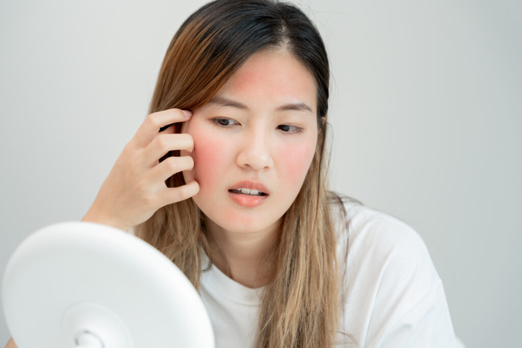Cách thải độc da nhiễm Corticoid tại nhà hiệu quả mà bạn chưa biết