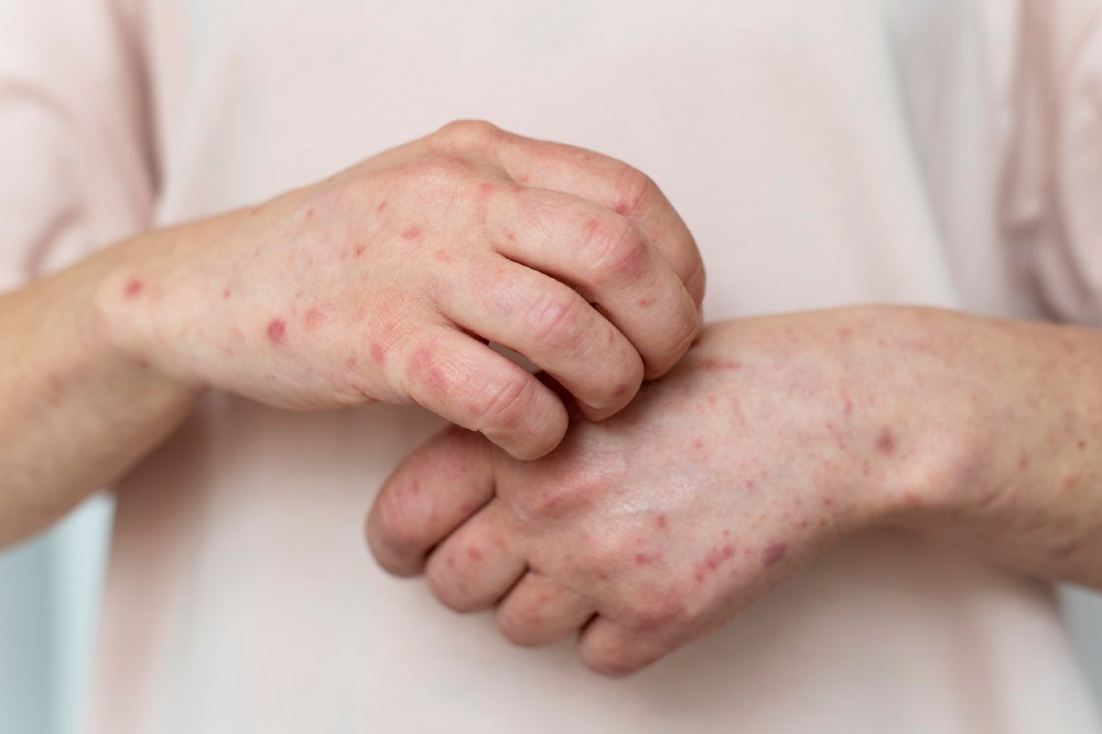 Ampicillin có thể gây ra tác dụng phụ trong một số trường hợp nhất định
