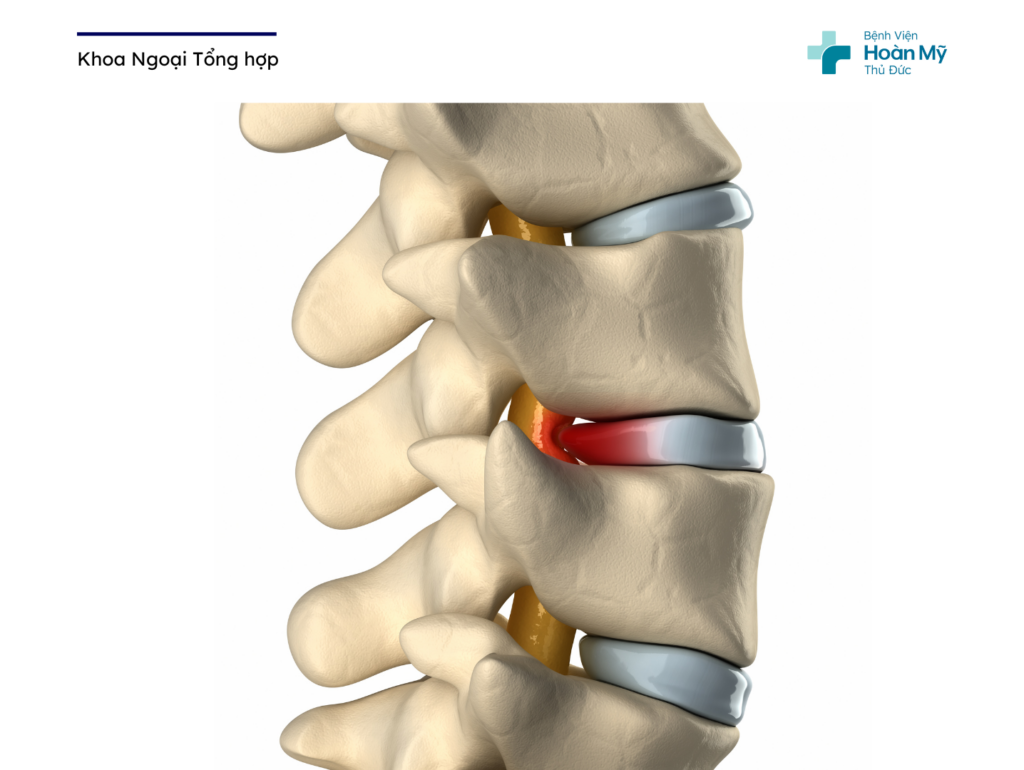 Hẹp ống sống thắt lưng: Nguyên nhân, triệu chứng và phương pháp chữa trị