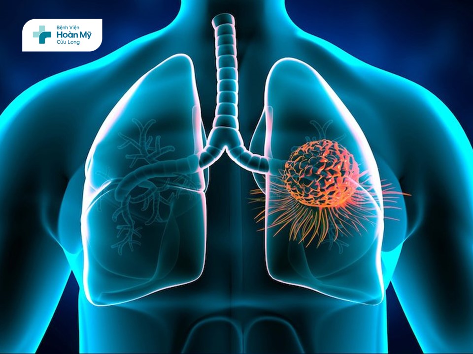 Phù phổi cấp: Chẩn đoán và điều trị