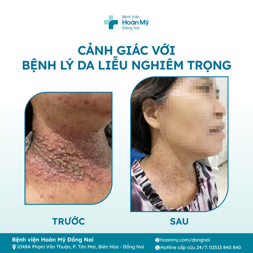 Eczema Herpeticum: Cảnh giác với bệnh lý da liễu nghiêm trọng