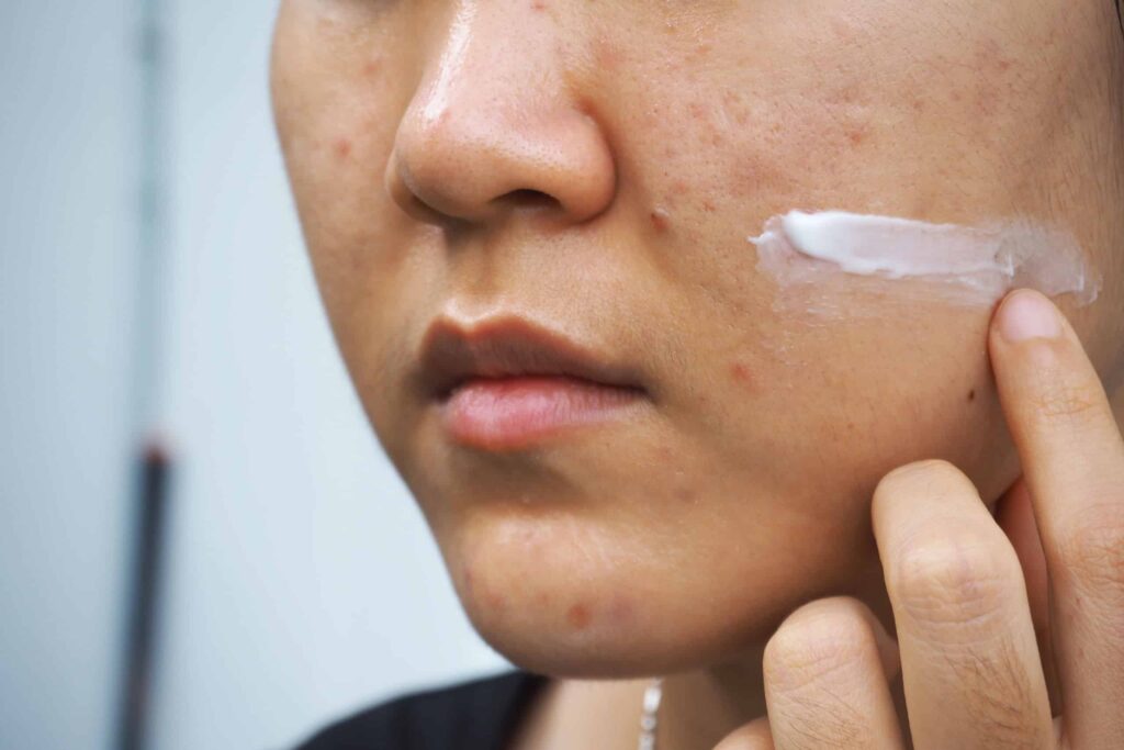 Sử dụng thuốc bôi để khắc phục tình trạng mụn 