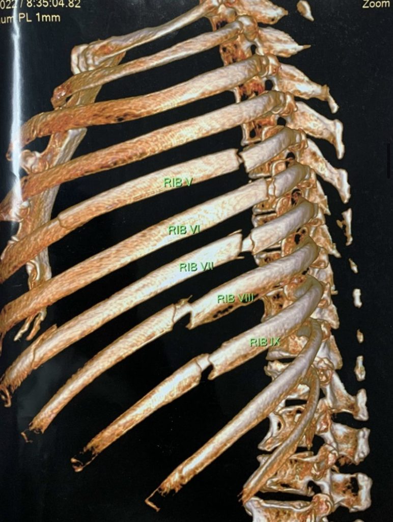 Phẫu thuật cố định xương sườn cho cụ ông bị chấn thương lồng ngực sau tai nạn giao thông