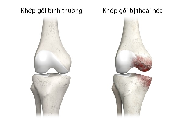 Chấm dứt nguy cơ tàn phế với phương pháp phẫu thuật thay khớp gối nhân tạo 