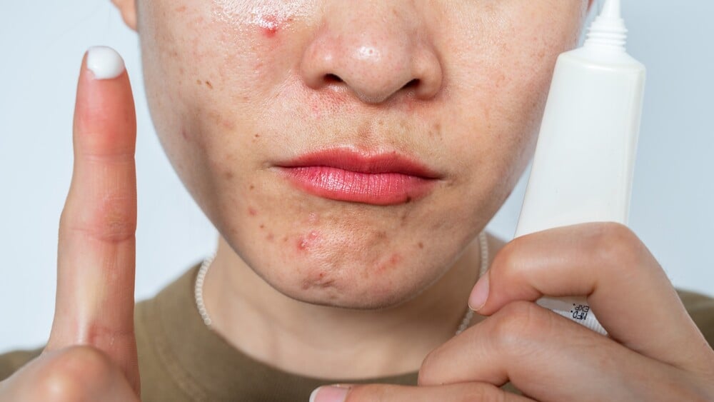 Thuốc Isotretinoin là gì? Công dụng, lưu ý tác dụng phụ