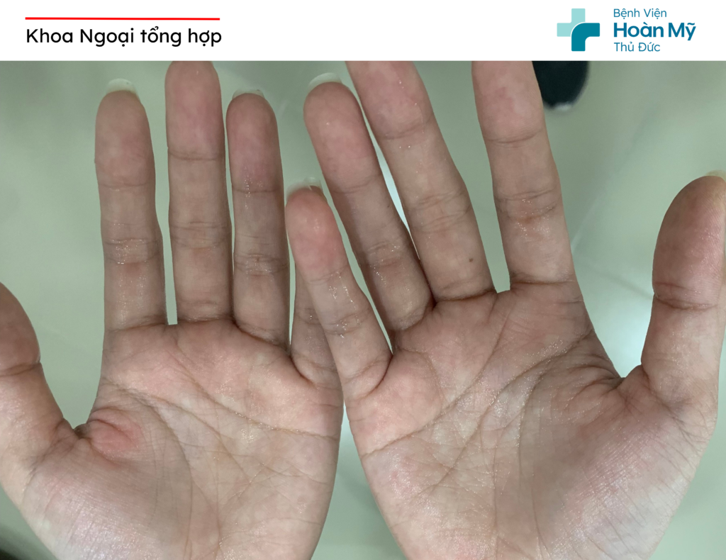 Tăng tiết mồ hôi: Nguyên nhân, triệu chứng và phương pháp điều trị