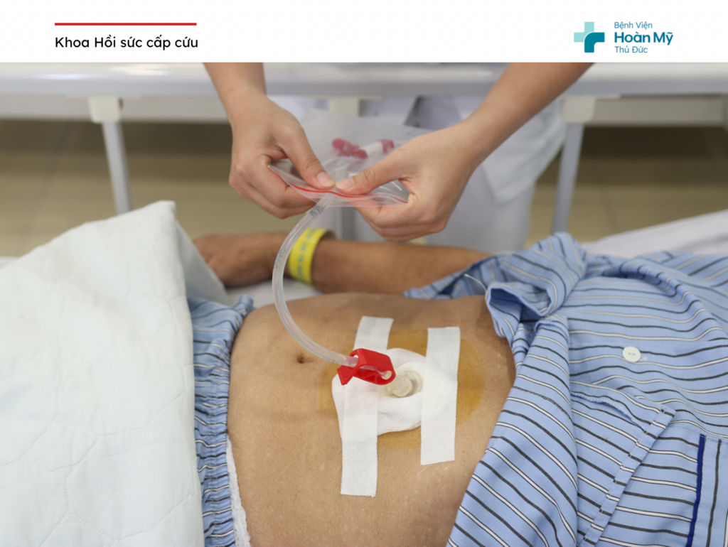 Mở thông dạ dày ra da thông qua nội soi giúp phòng ngừa hít sặc cho người bệnh