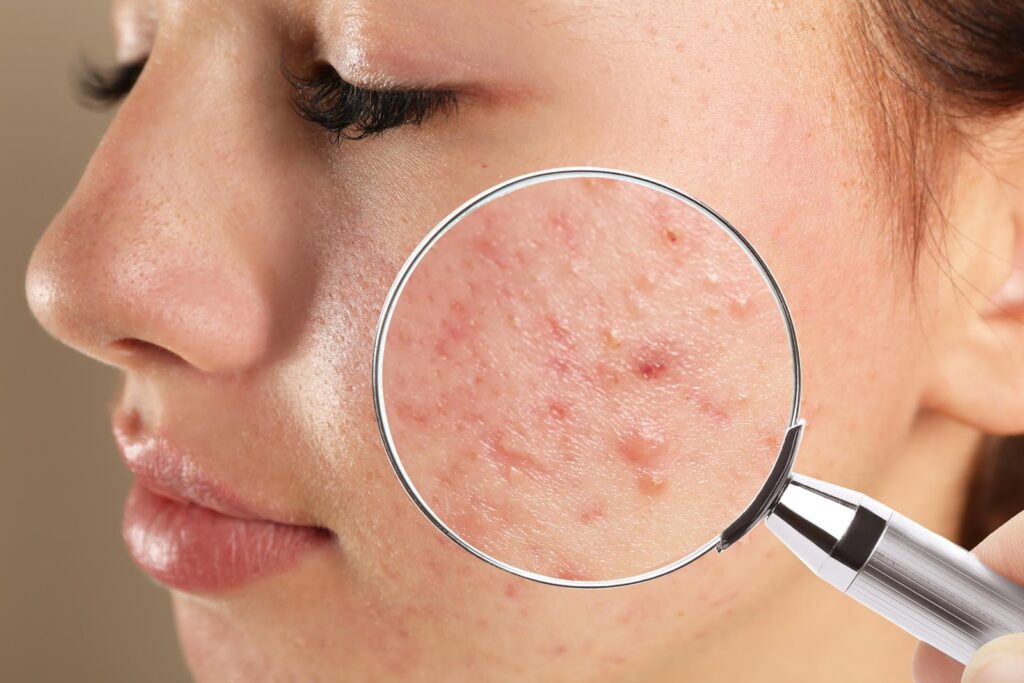 10+ cách trị mụn an toàn, hiệu quả và không tốn nhiều chi phí