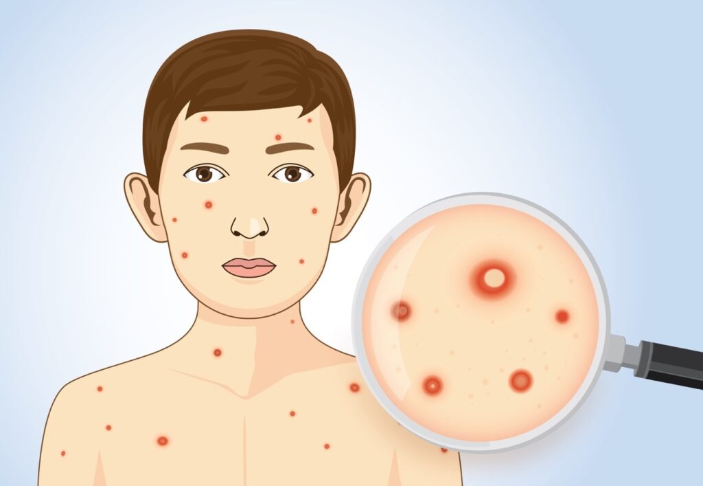 Phương pháp chẩn đoán bệnh thủy đậu