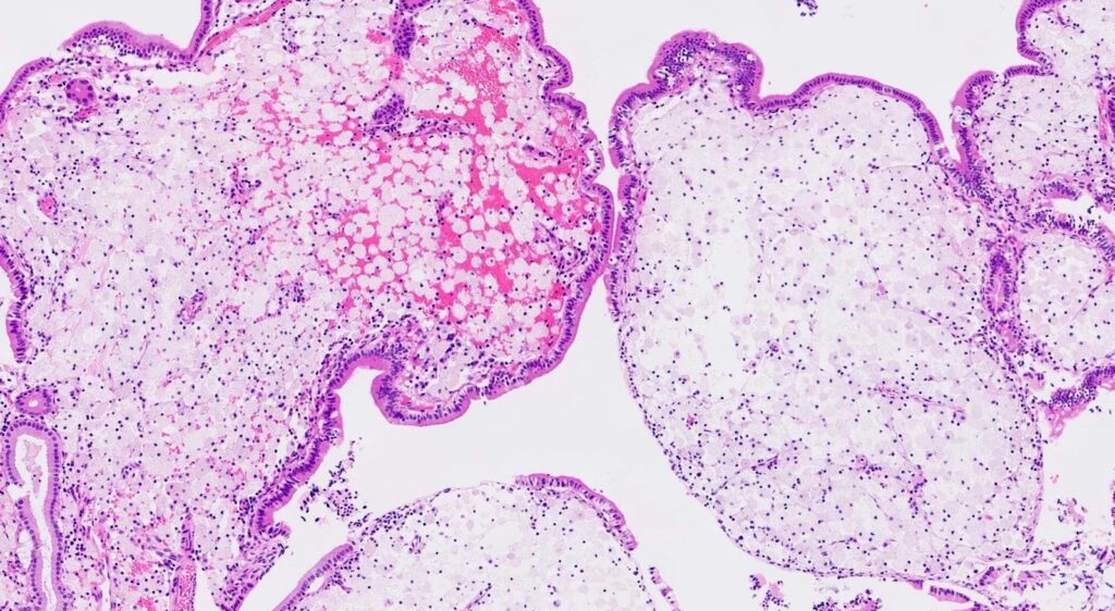 Các thể polyp cholesterol thường có kích thước nhỏ