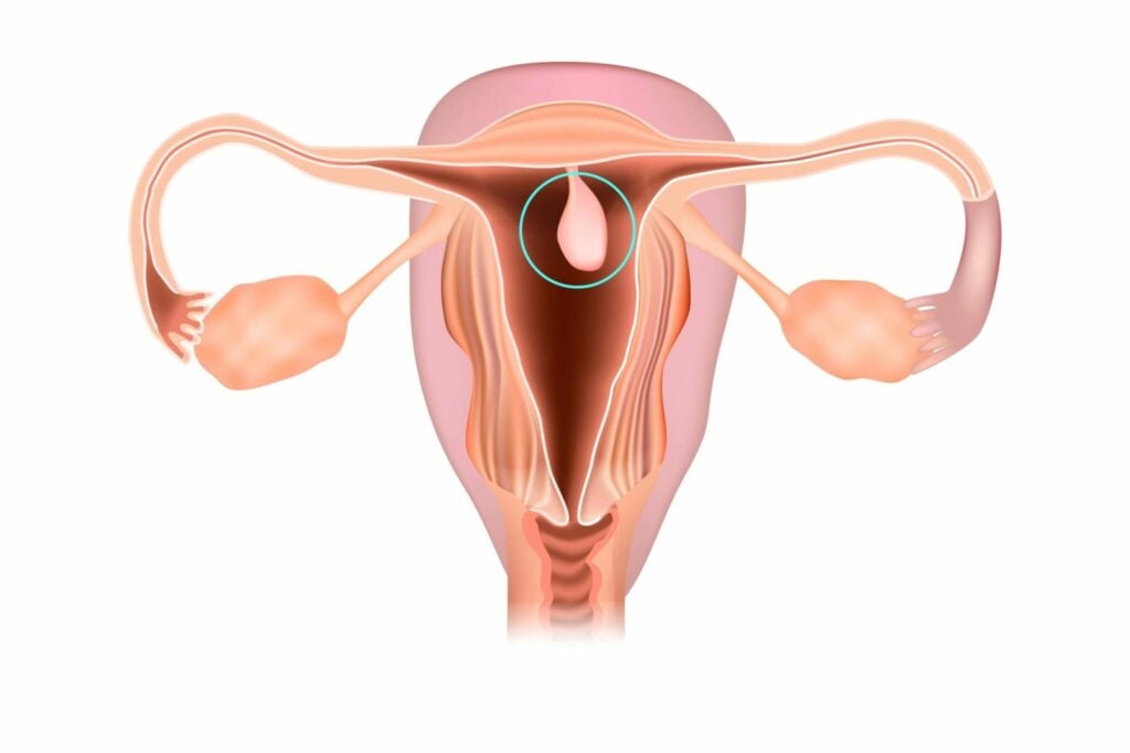 Giải đáp thắc mắc: Polyp tử cung có nguy hiểm không?
