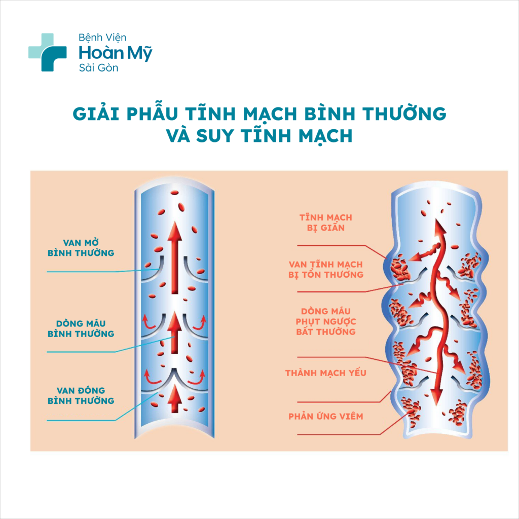 Cách phòng ngừa, điều trị suy giãn tĩnh mạch để tránh biến chứng về sau