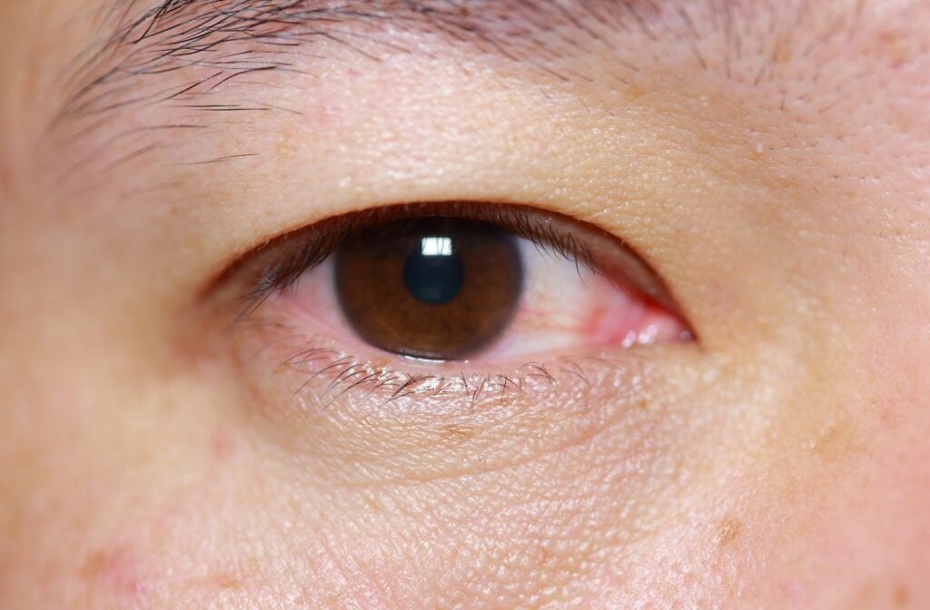 Triệu chứng viêm kết mạc do virus