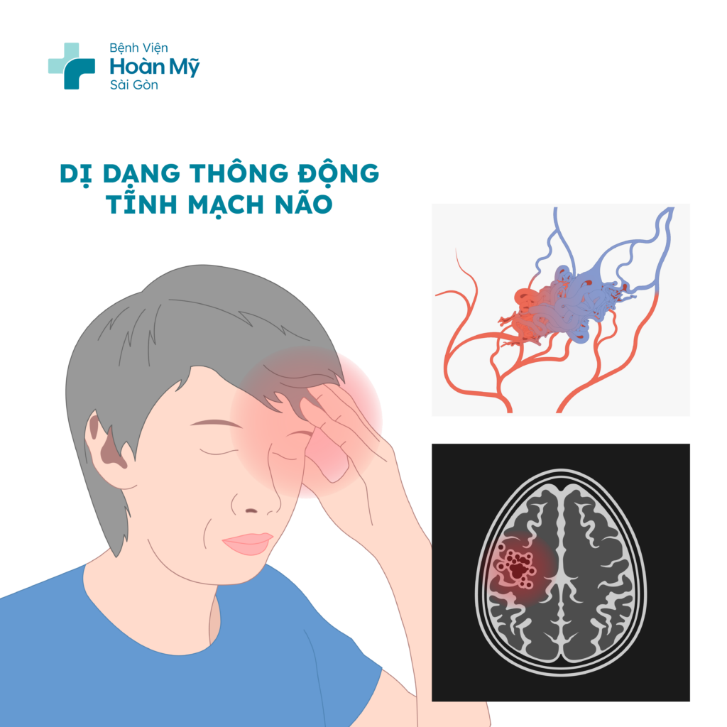 Trong khoảng một nửa số ca dị dạng mạch máu não, xuất huyết là dấu hiệu đầu tiên.
