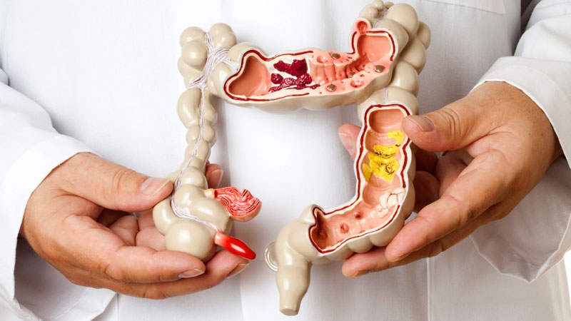 Viêm đại tràng: Nguyên nhân, triệu chứng và phác đồ điều trị
