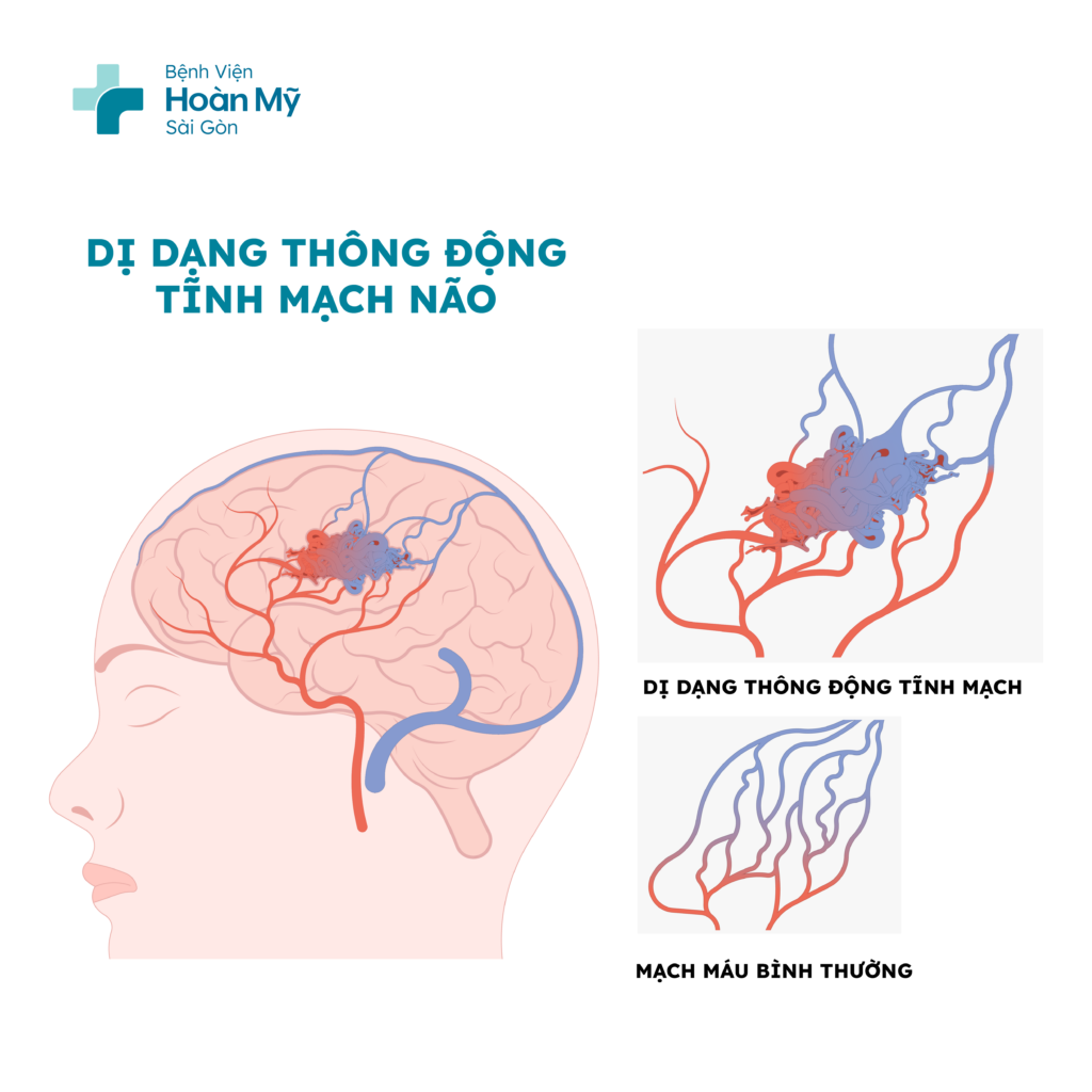 Xuất huyết não, tổn thương não,... là một số biến chứng nguy hiểm của dị dạng mạch máu não
