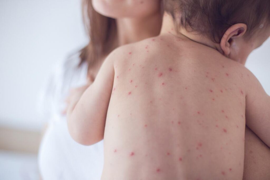 Bệnh sởi: Nguyên nhân, triệu chứng, cách điều trị và phòng ngừa