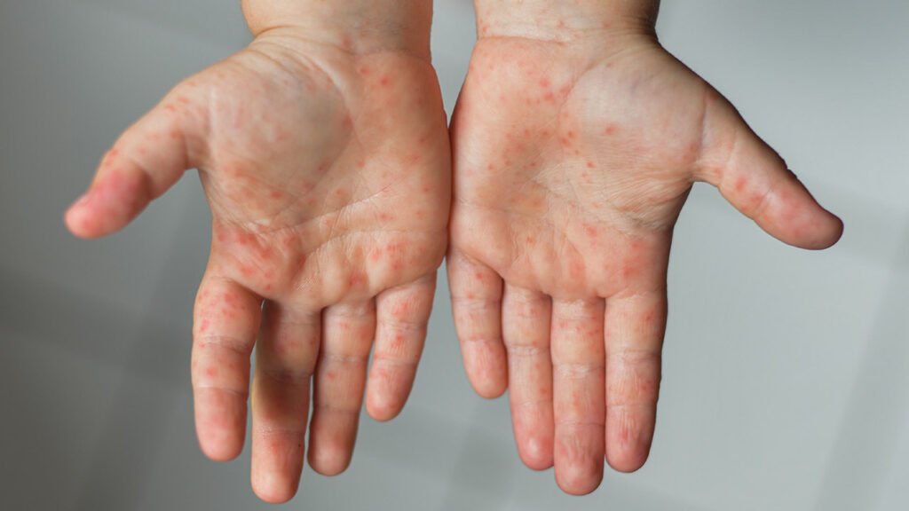 Bệnh tay chân miệng: Nguyên nhân, triệu chứng và cách điều trị