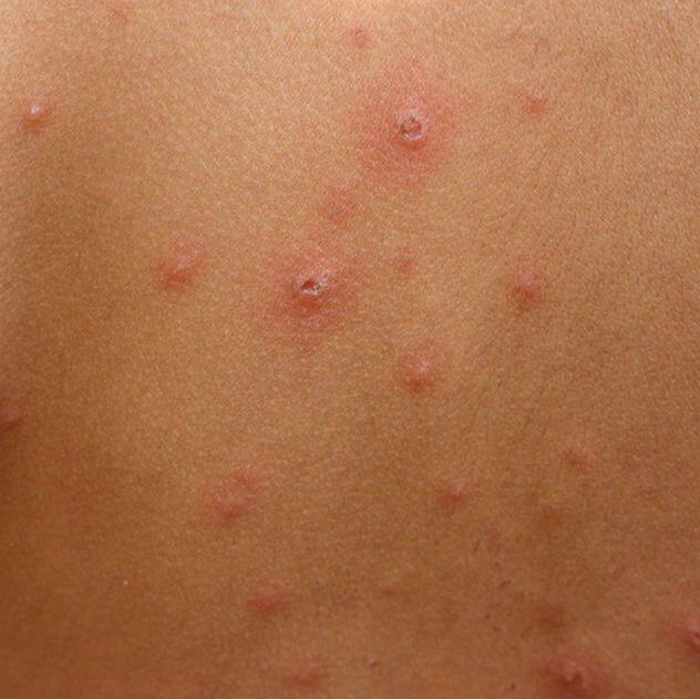 Bệnh thủy đậu có lây không? Thủy đậu (trái rạ) lây qua đường nào?