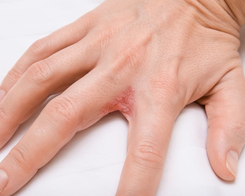 Bệnh tổ đỉa: Nguyên nhân, cách điều trị và phòng ngừa