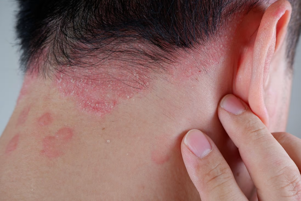 triệu chứng bị bệnh vảy nến: da đỏ tấy, xuất hiện vảy trắng, khô, nứt nẻ, ngứa ngáy