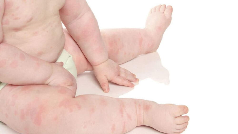 Bị vảy nến nặng có thể gây ra nhiều biến chứng khó lường