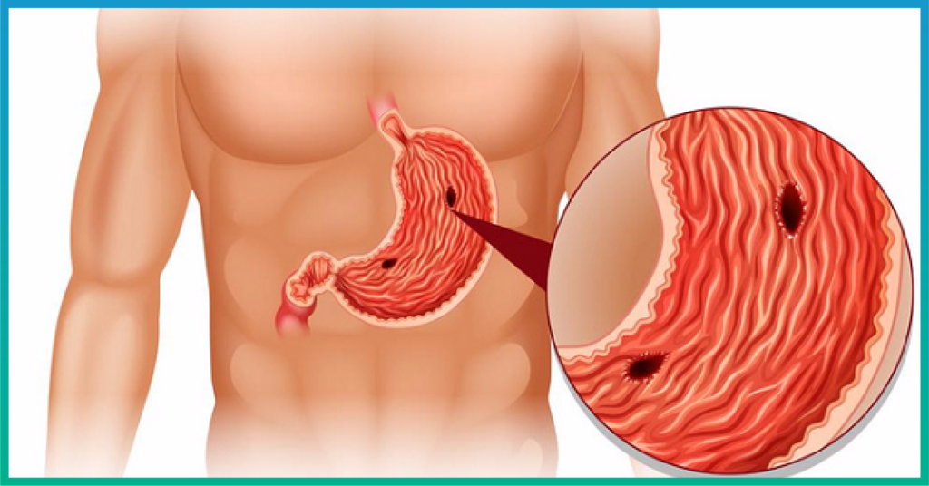 Tình trạng đau lâu ngày có thể bị thủng dạ dày