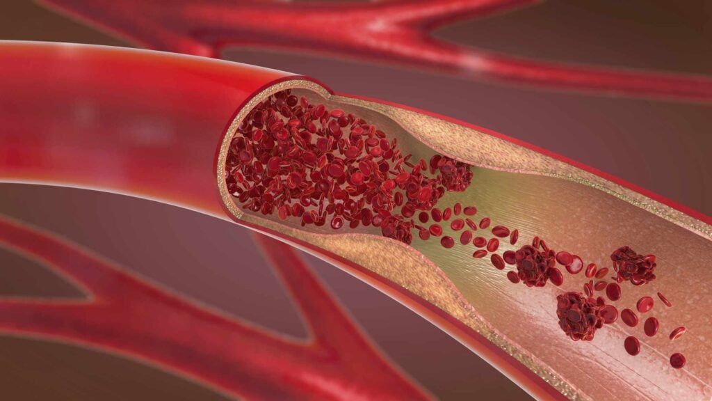 Biến chứng khi chỉ số Triglyceride cao 