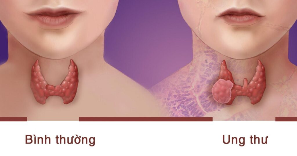 Biểu hiện ung thư tuyến giáp