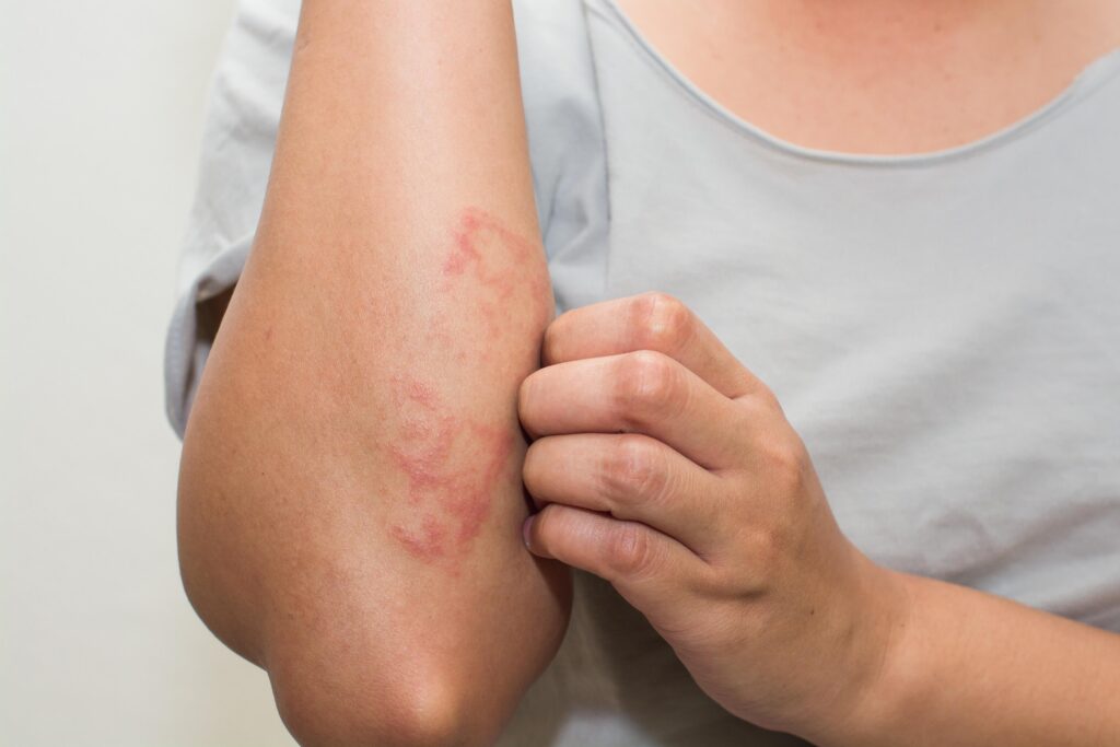 Diếp hoang hỗ trợ điều trị bệnh lý ngoài da do nhiễm nấm, nhiễm khuẩn 