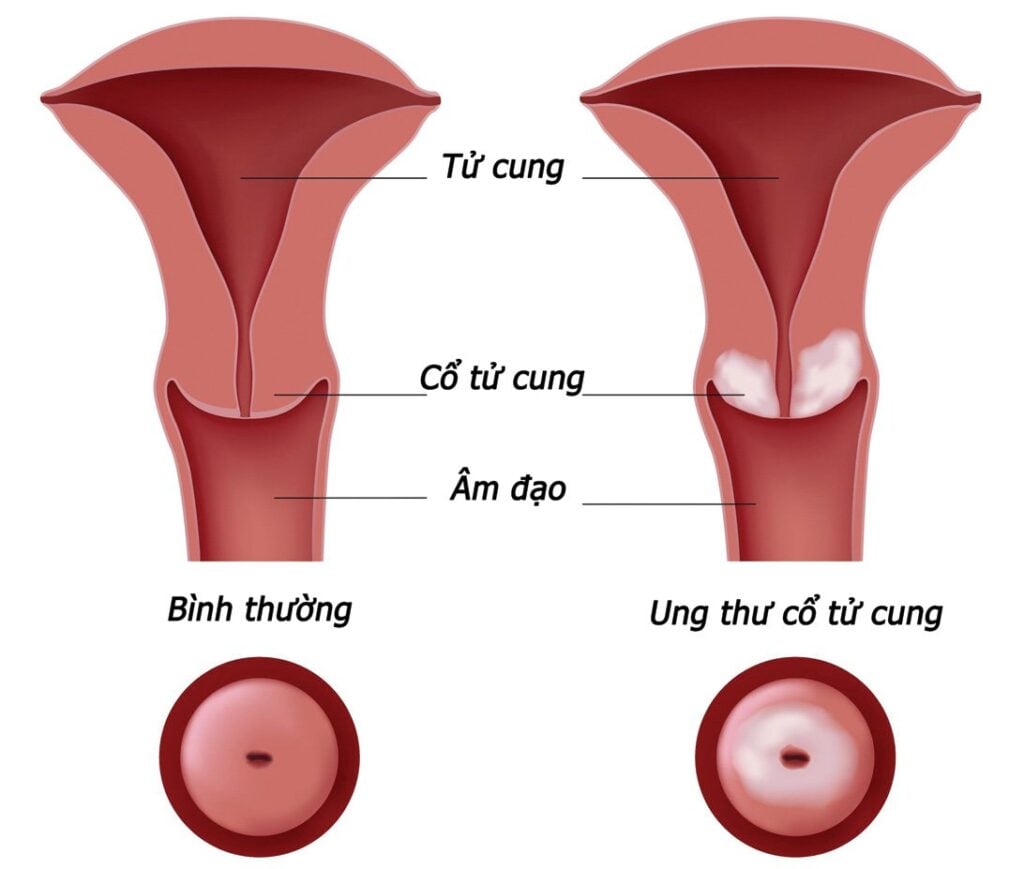 Khi hư bã đậu cũng là dấu hiệu của ung thư cổ tử cung 