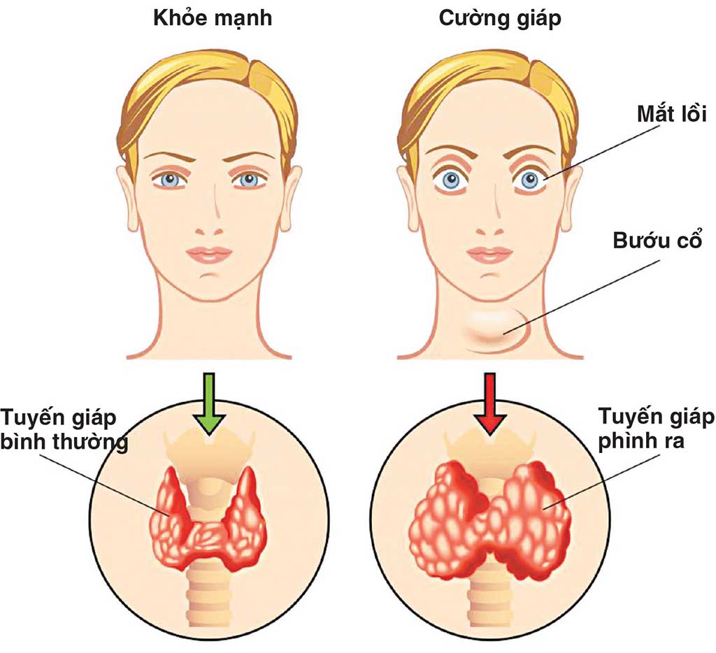 Các triệu chứng của bướu cổ