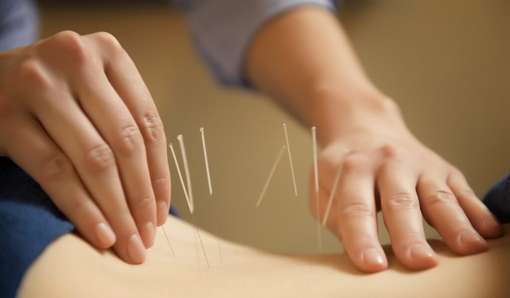 Châm cứu cũng là một phương pháp điều trị hen suyễn hiệu quả 