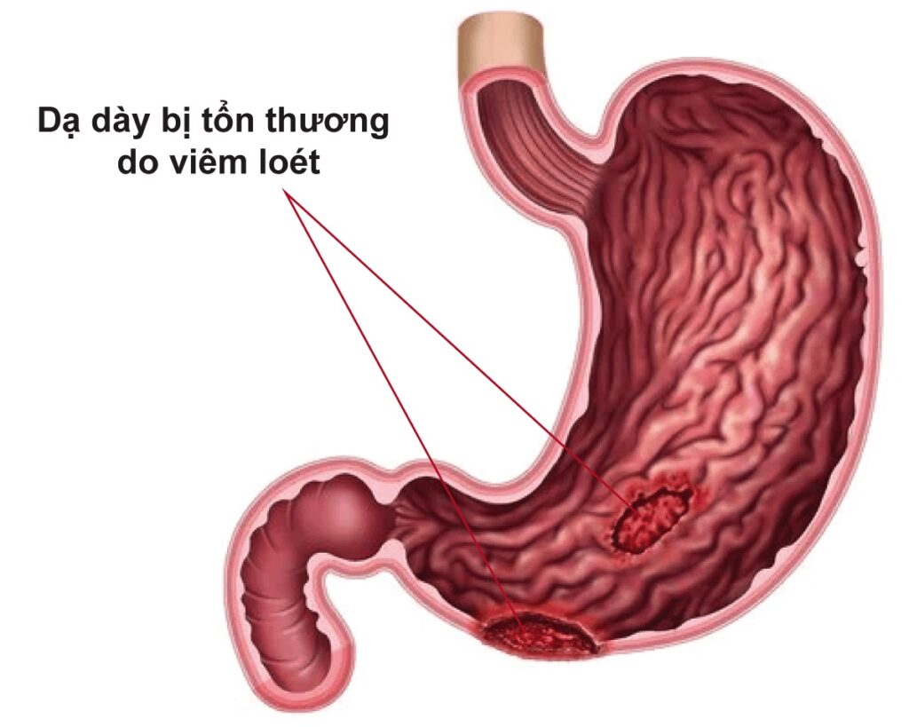 Bạc hà còn giúp phòng ngừa bệnh viêm loét dạ dày 