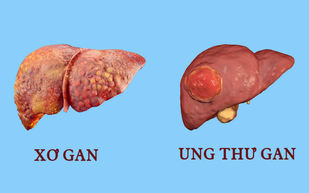 Cây bạch tuộc ngâm rượu trắng chữa bệnh về gan 