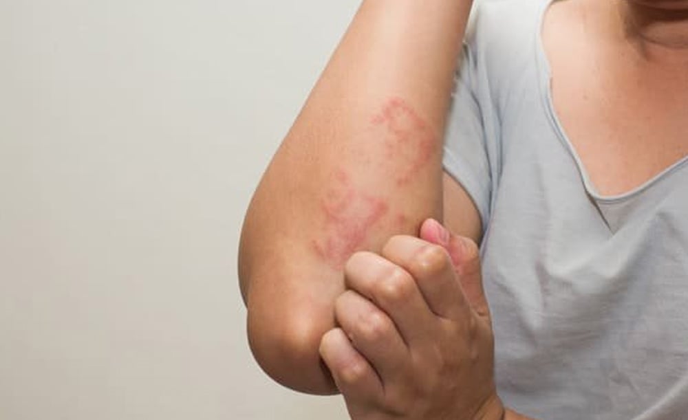 Cetirizin có tác dụng chữa trị và làm giảm các triệu chứng dị ứng