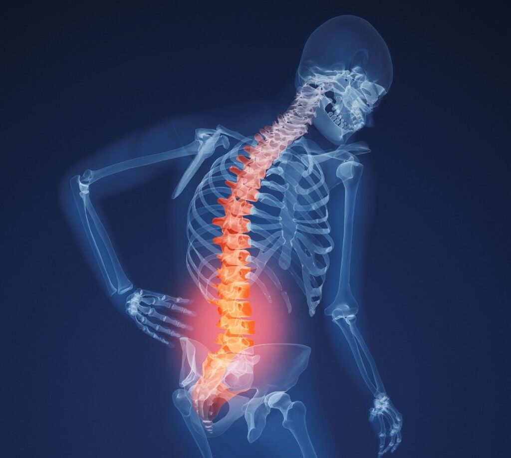 Phương pháp chụp CT để chẩn đoán loãng xương
