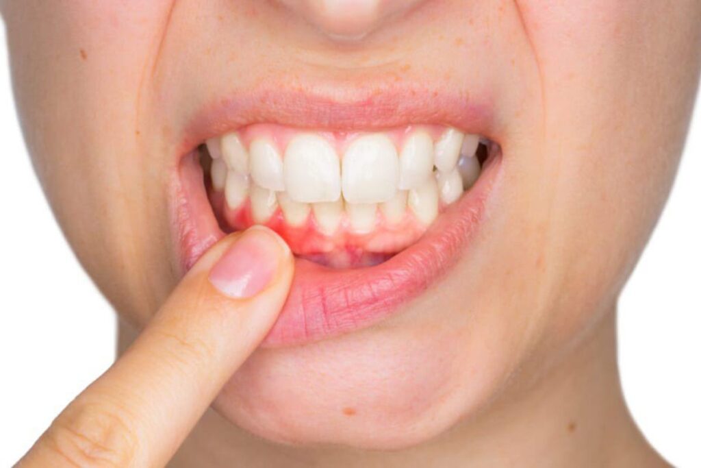 Chảy máu chân răng là gì? Nguyên nhân và cách chữa trị
