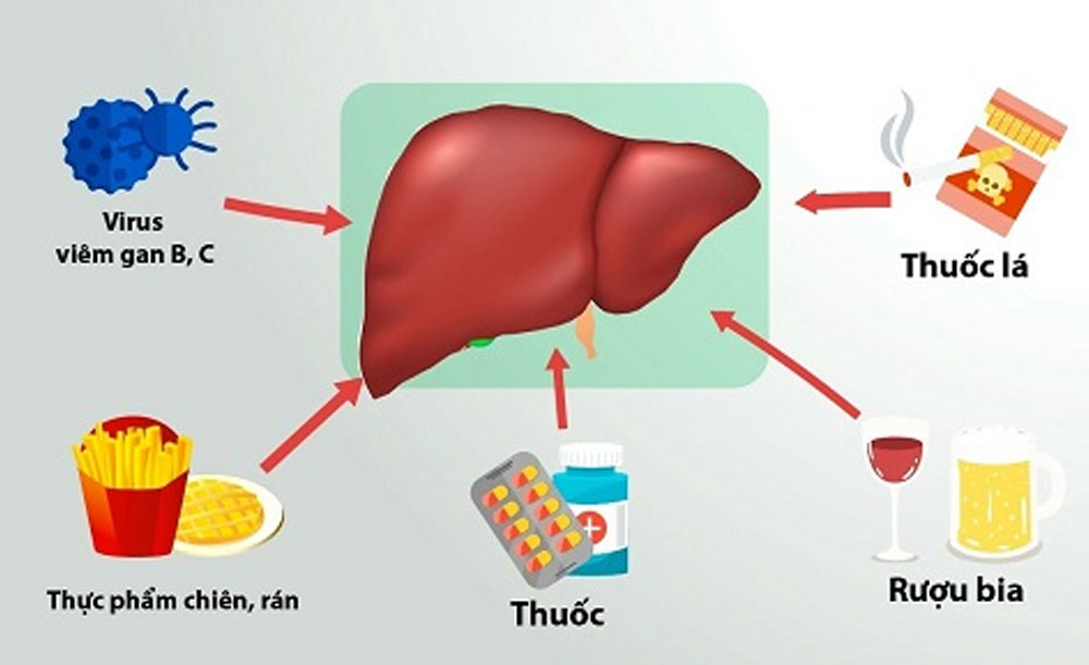 Những nguyên nhân làm tăng chỉ số men gan