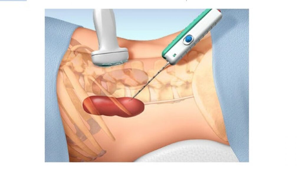 Lấy dịch để làm giảm kích thước và gây xơ hóa nang