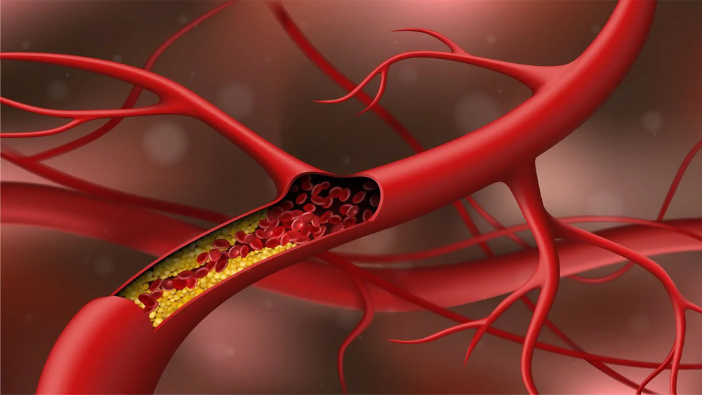 Phân loại các loại cholesterol và cách phòng tránh mỡ trong máu