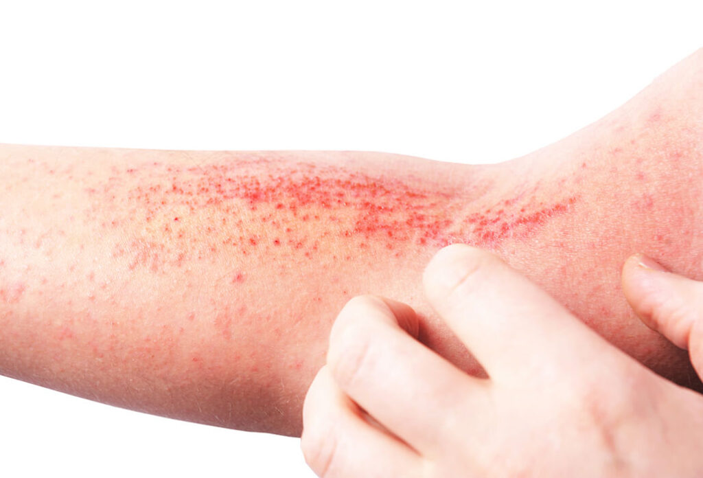 Cây vòi voi có thể điều trị và kiểm soát viêm da cơ địa