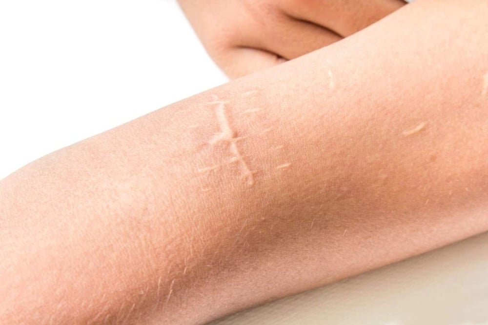 Contractubex: Công dụng, liều dùng và một số lưu ý
